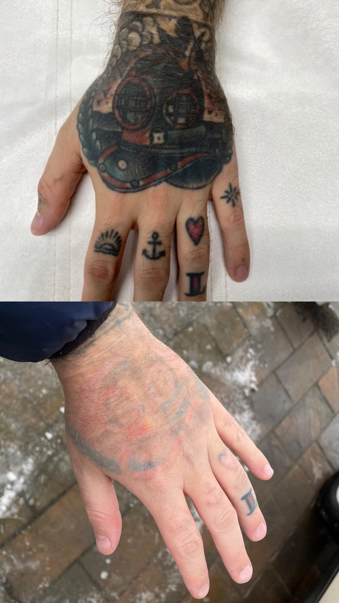 white tattoo before laser removal
