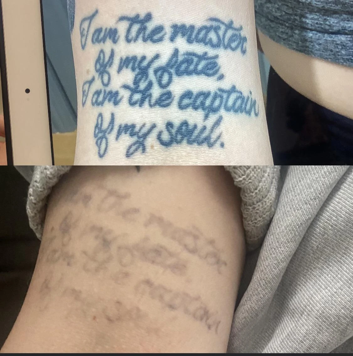 black tattoo before laser removal