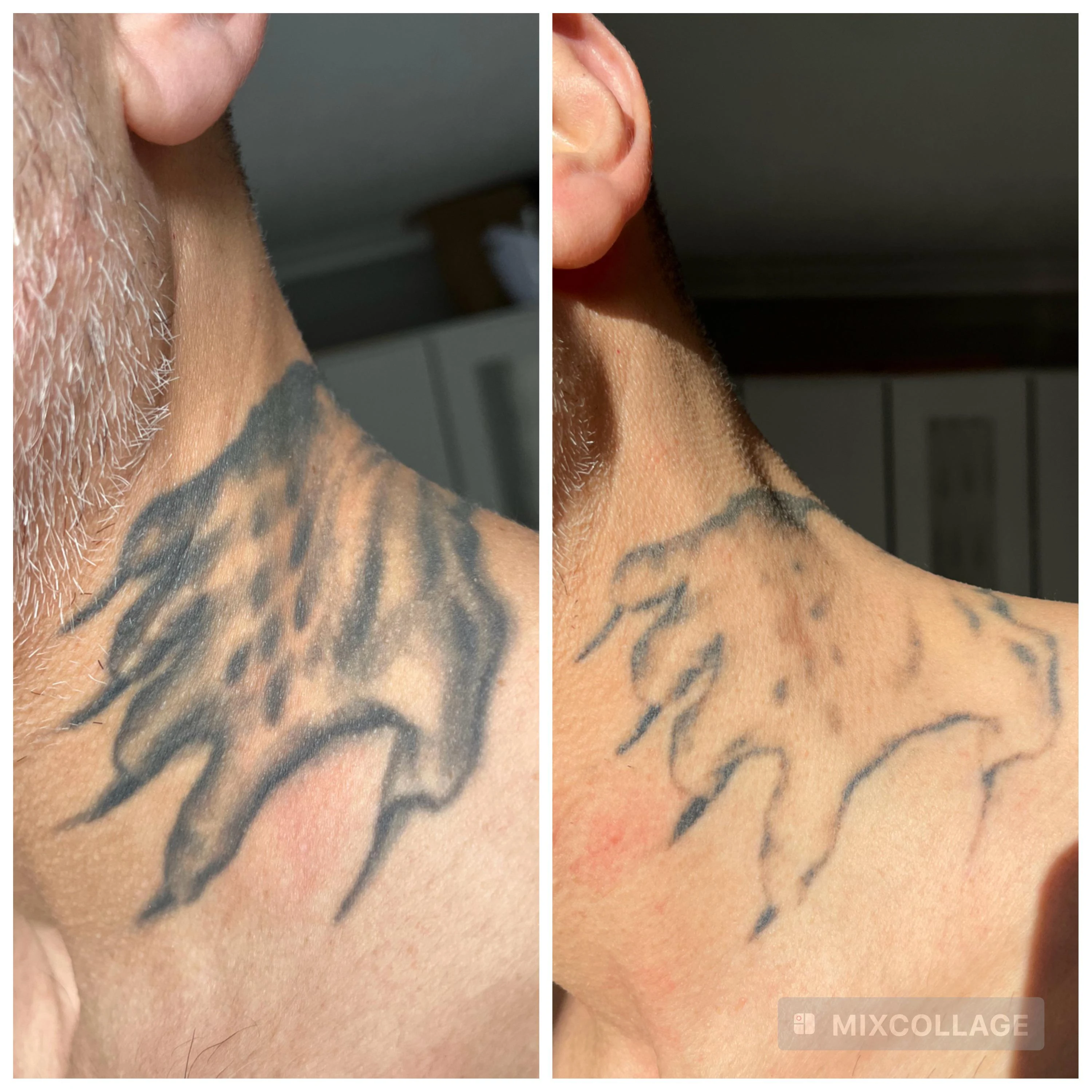 black tattoo before laser removal