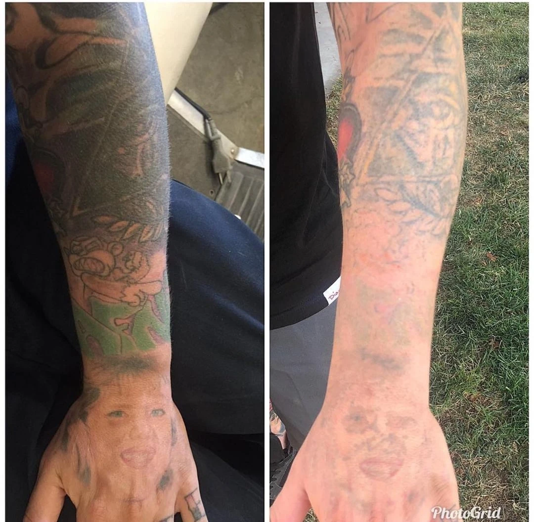 black tattoo before laser removal