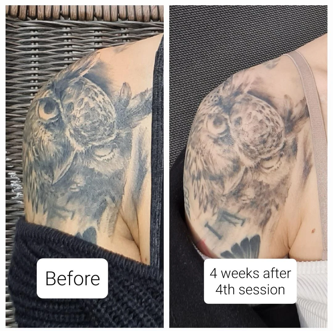 black tattoo before laser removal