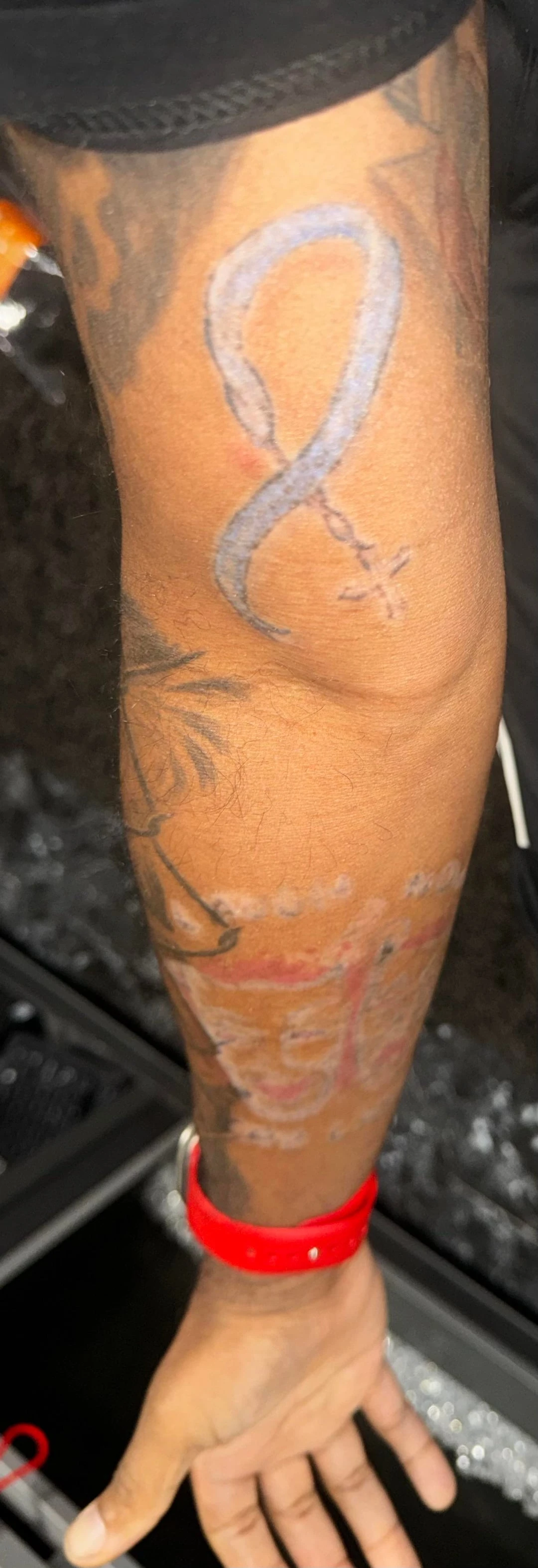 Medium Black And Red Tattoo on the Forearm After 1 Session: Minimal Visible Change So Far (25% Fading)