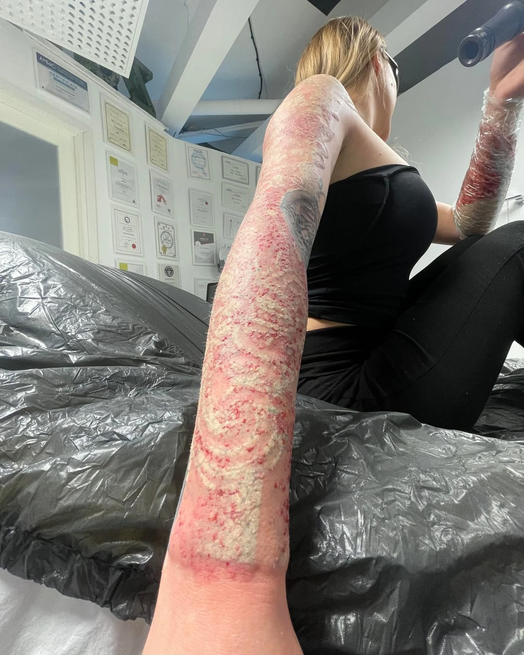 black tattoo after 4 sessions