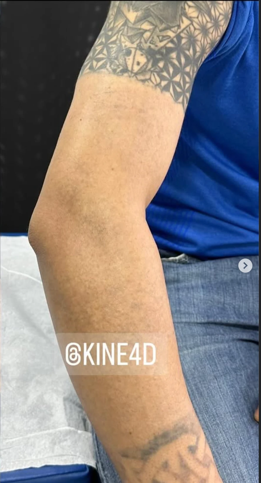 Large Black Tattoo on the Upper Arm After 1 Session: Minimal Visible Change So Far (100% Fading)