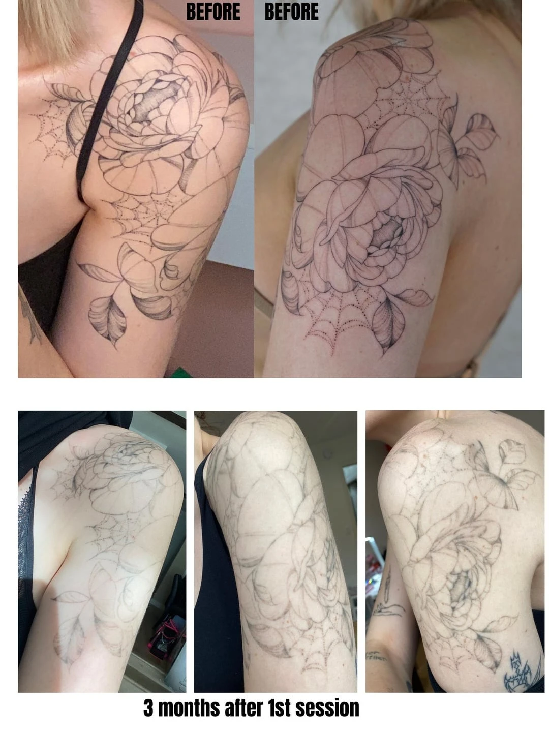 Large Black Tattoo on the Shoulder, Upper Arm After 2 Sessions: Minimal Visible Change So Far (75% Fading)