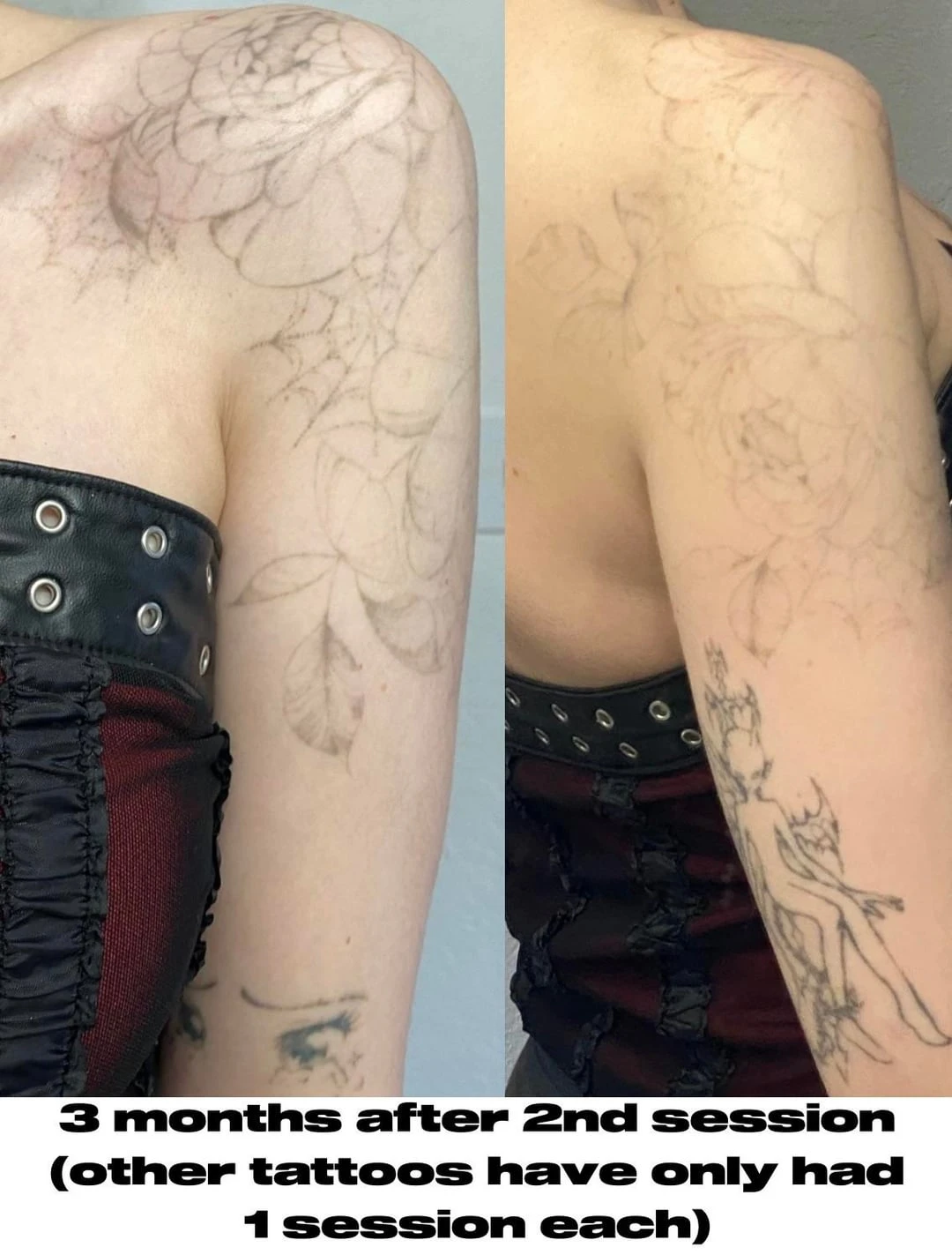 Black tattoo after 2 sessions