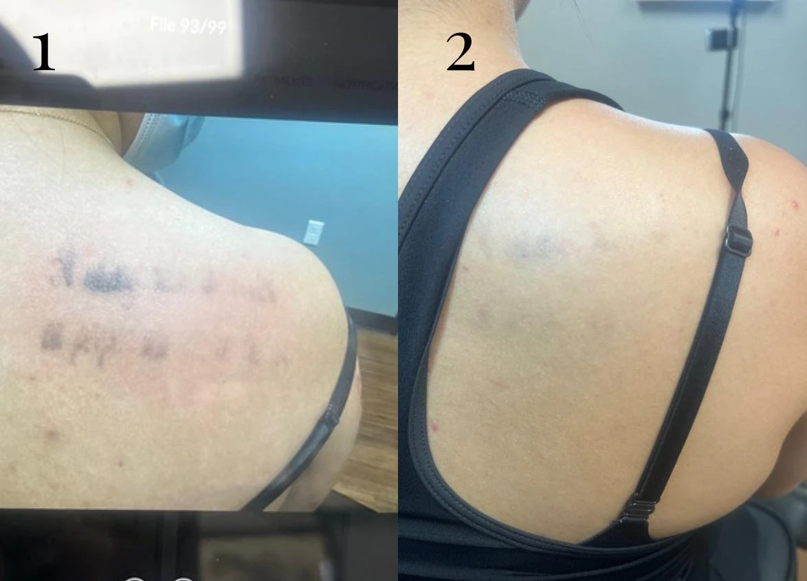 black tattoo before laser removal