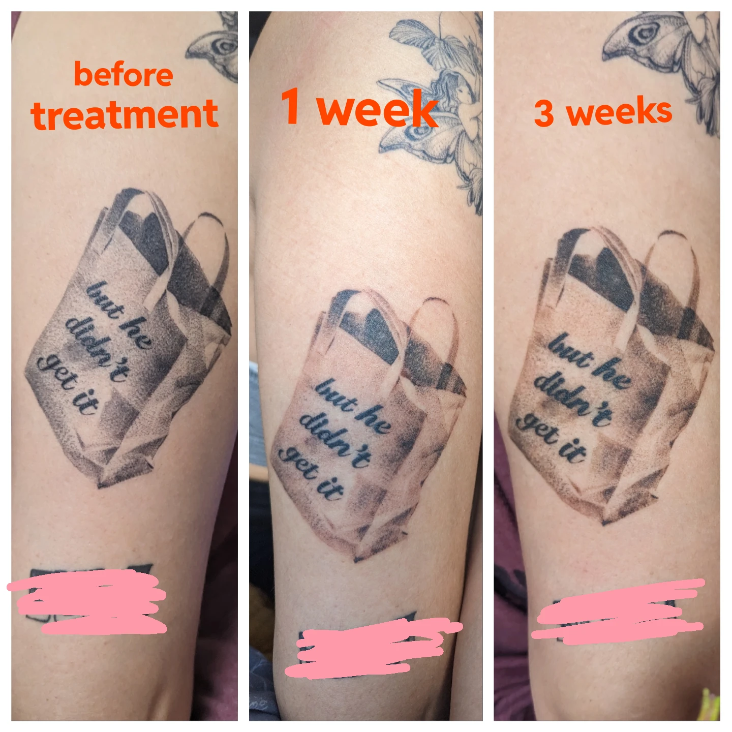 black tattoo before laser removal
