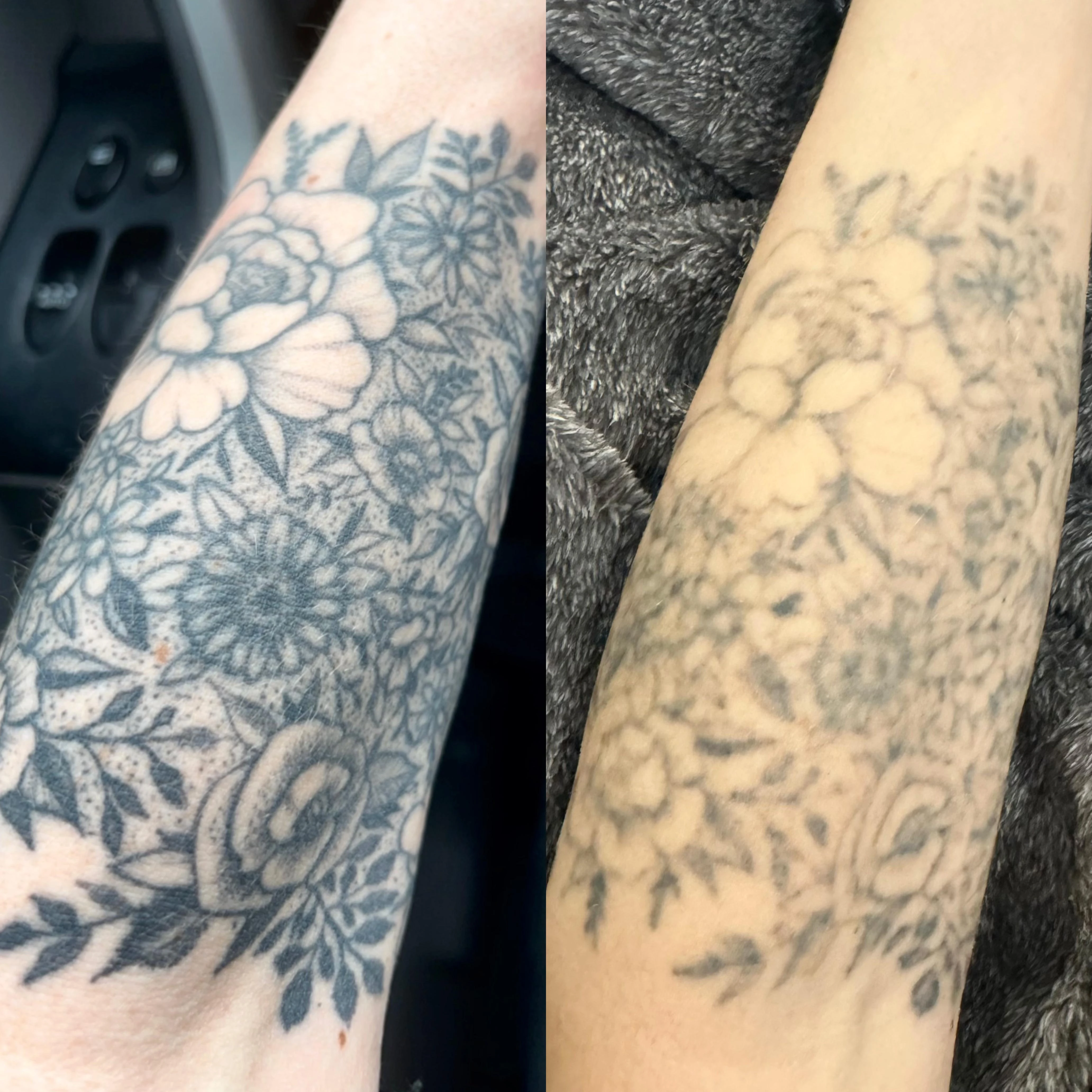white tattoo before laser removal