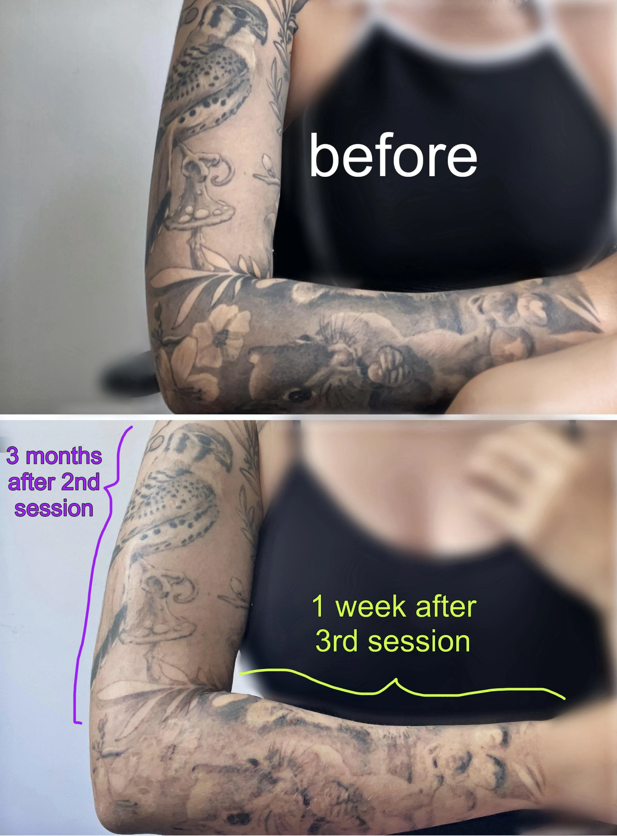 black tattoo before laser removal