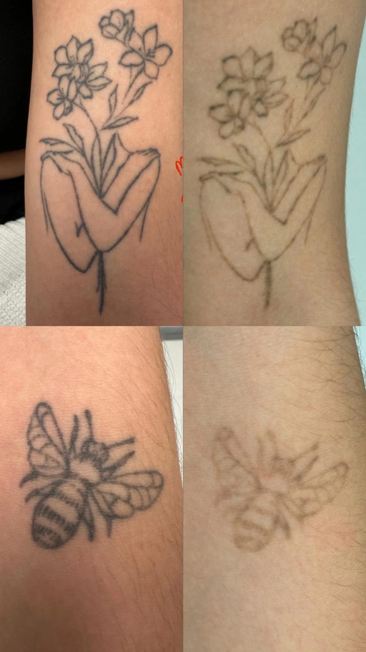 black tattoo before laser removal
