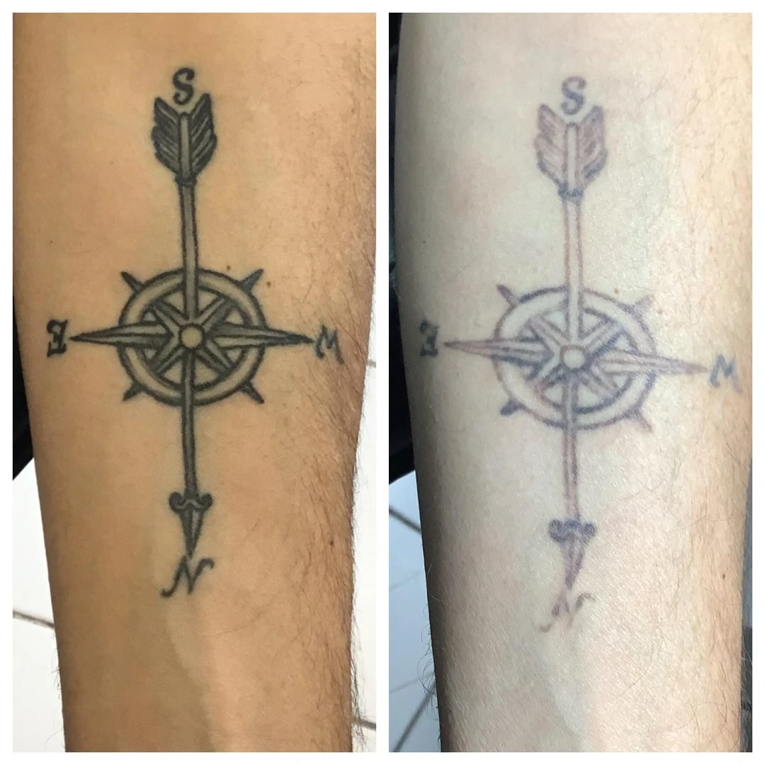 black tattoo after 12 sessions