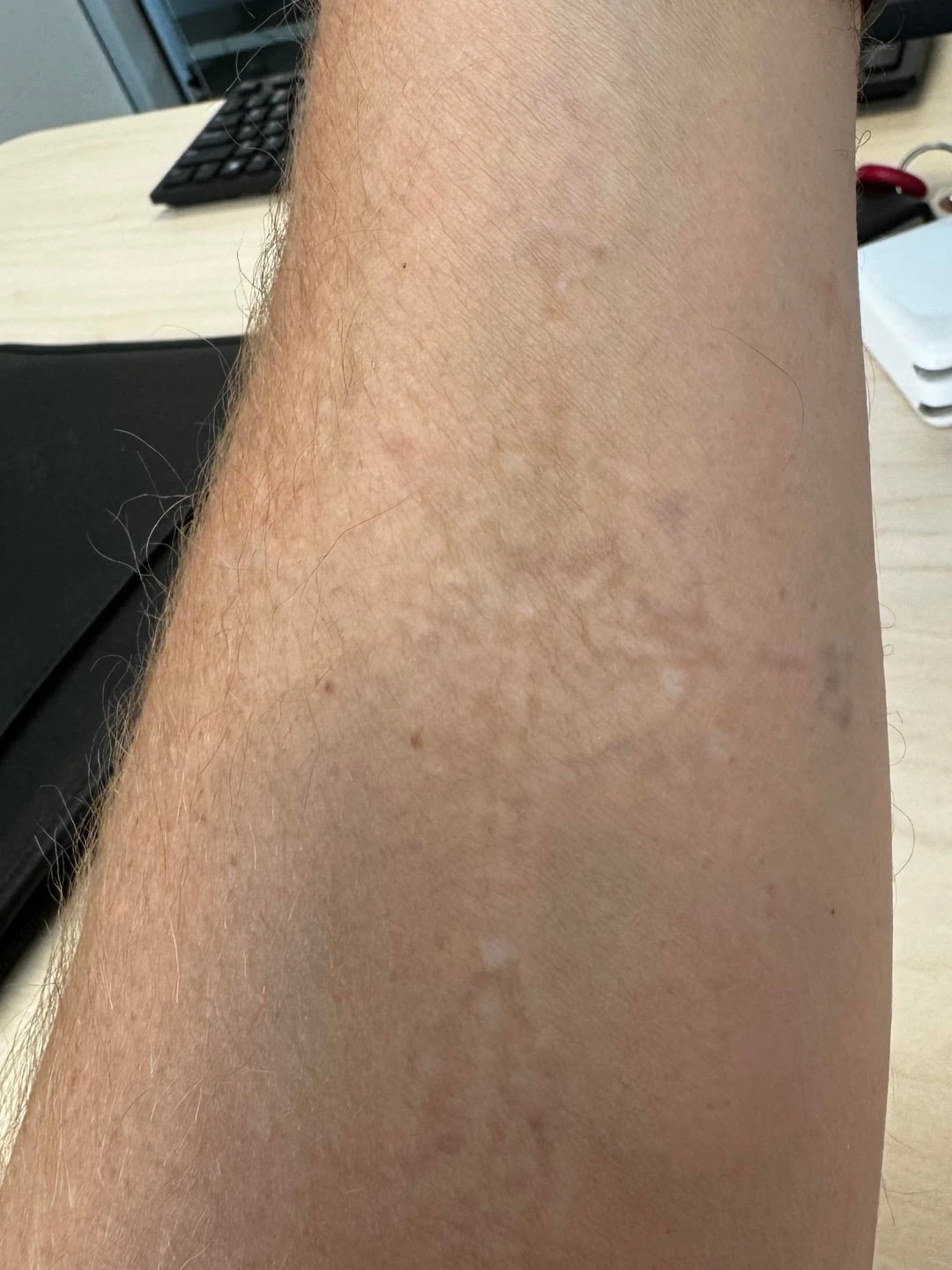 black tattoo before laser removal