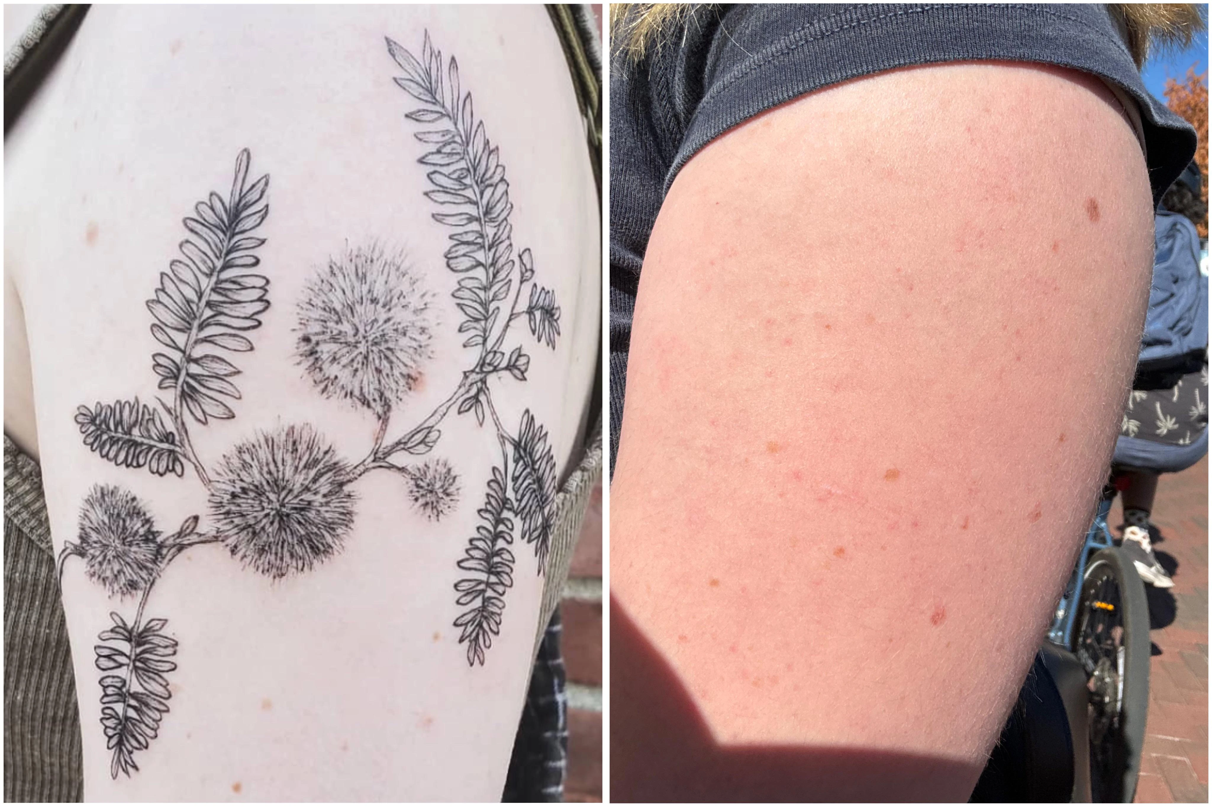 black tattoo before laser removal