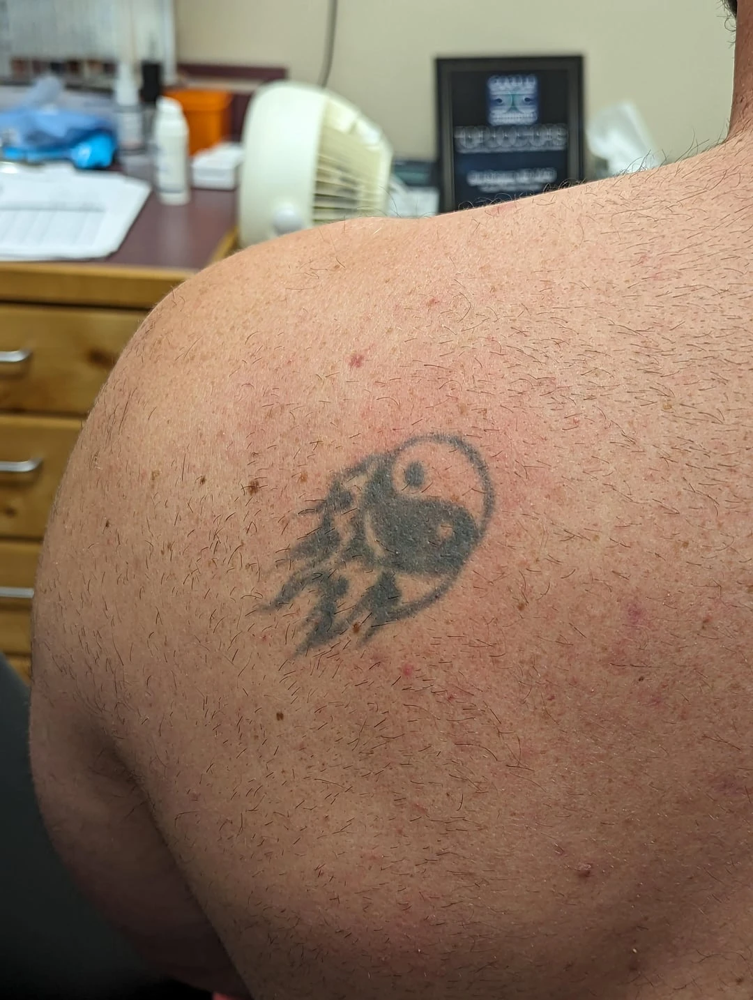 black tattoo before laser removal