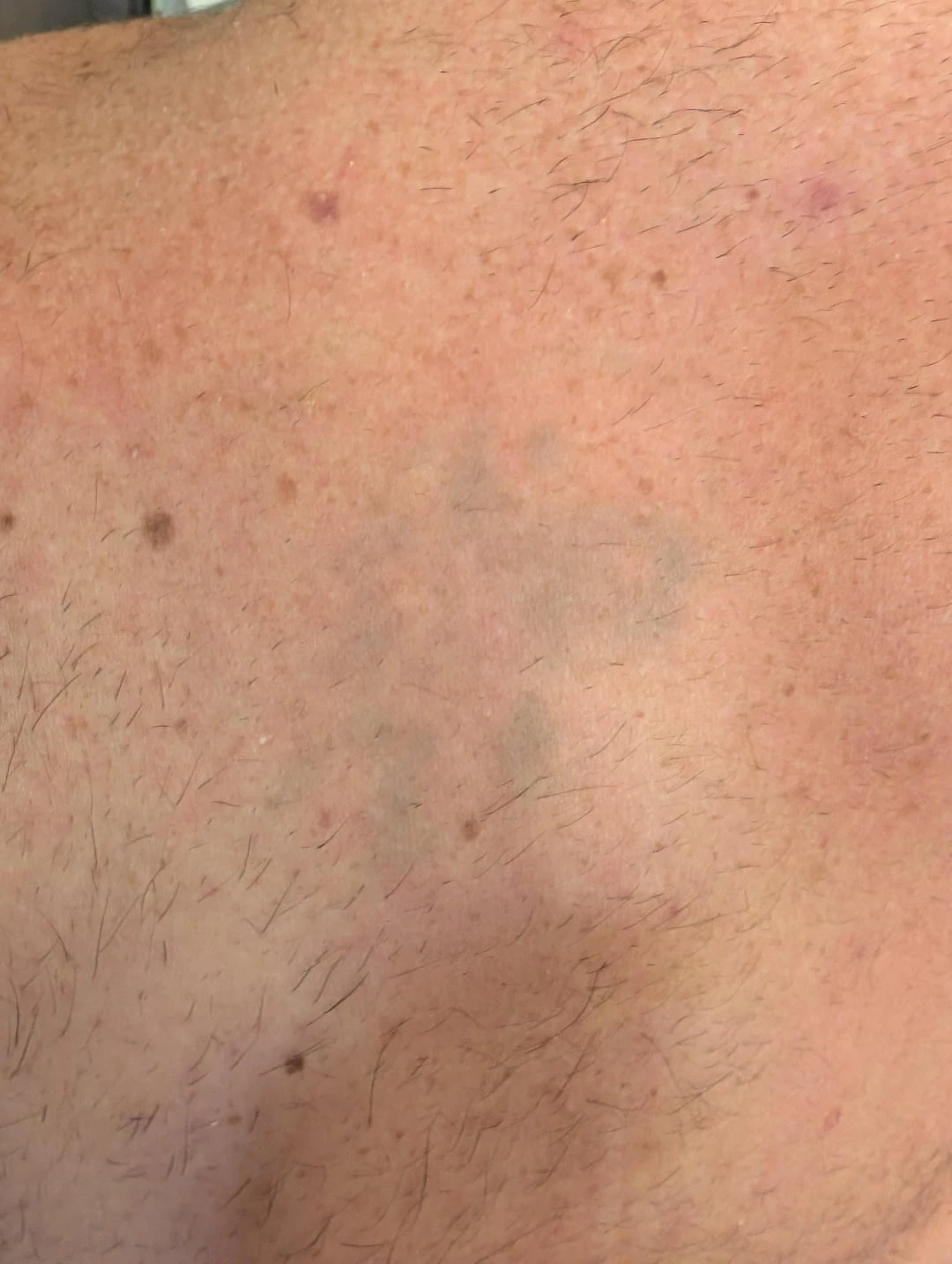 black tattoo after 5 sessions
