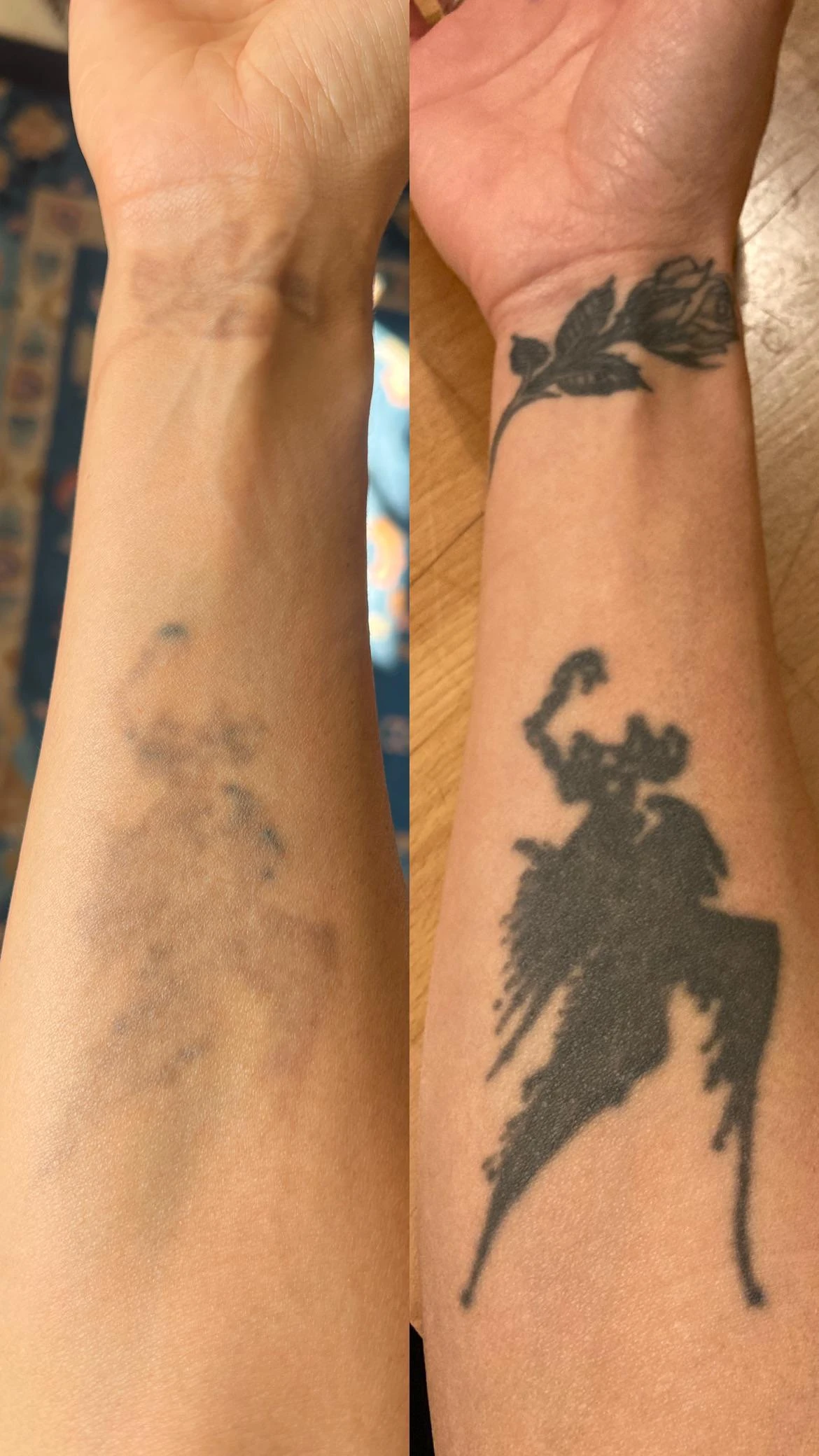 black tattoo before laser removal