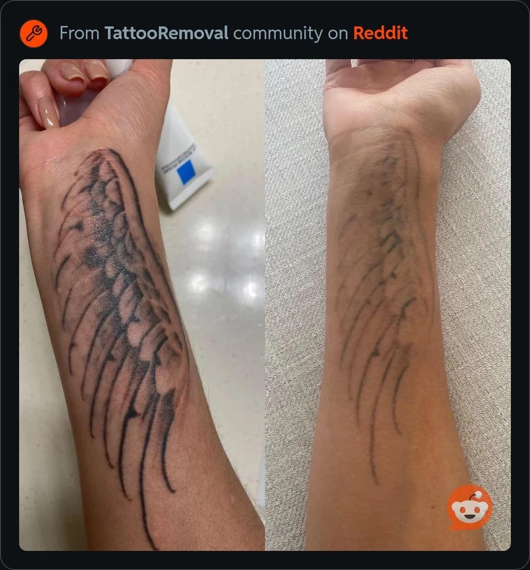 black tattoo before laser removal