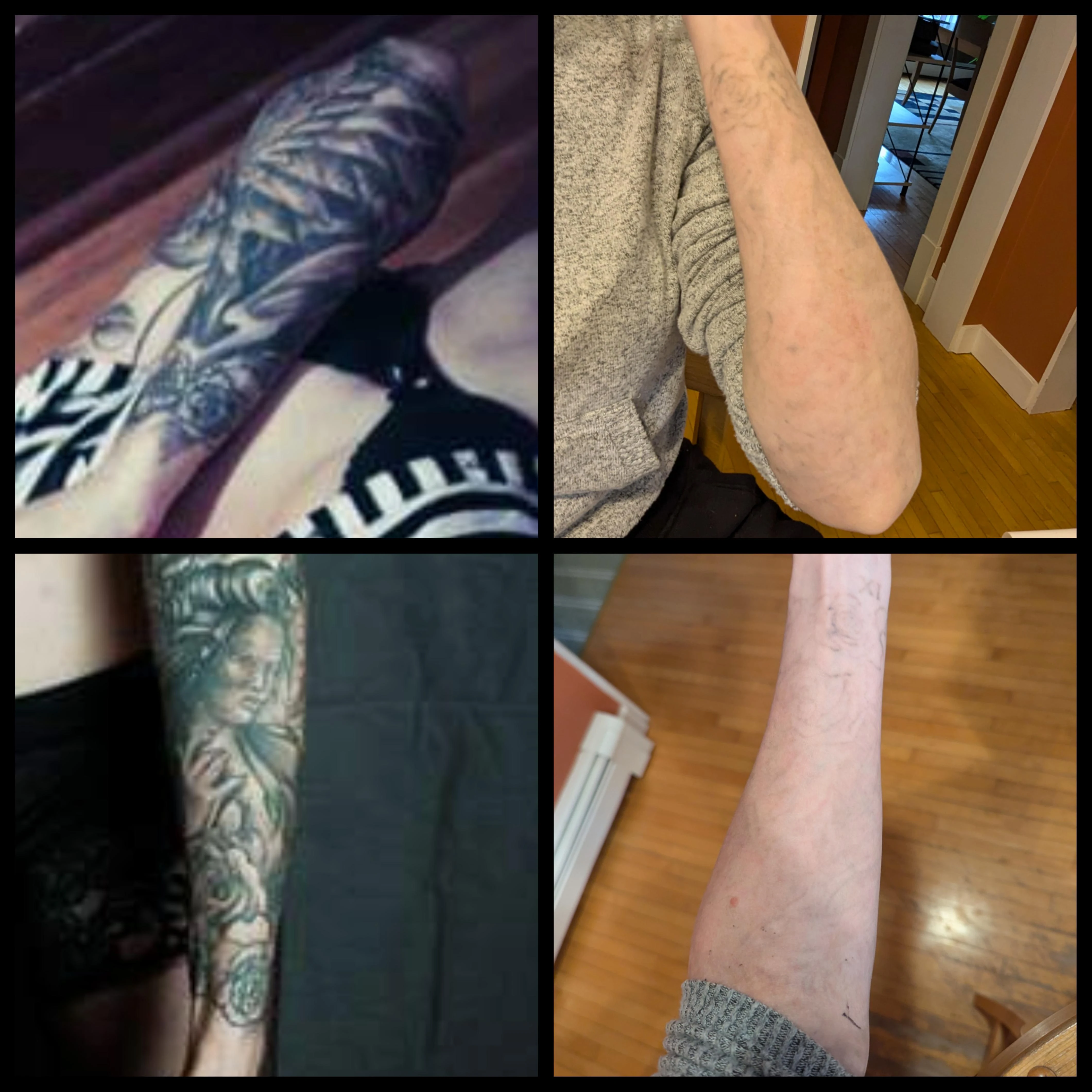 black tattoo before laser removal