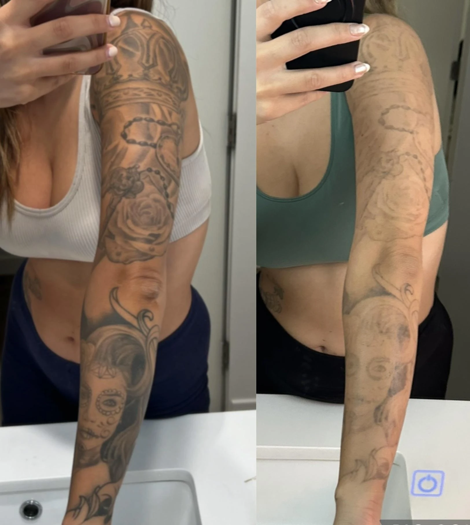 black tattoo before laser removal