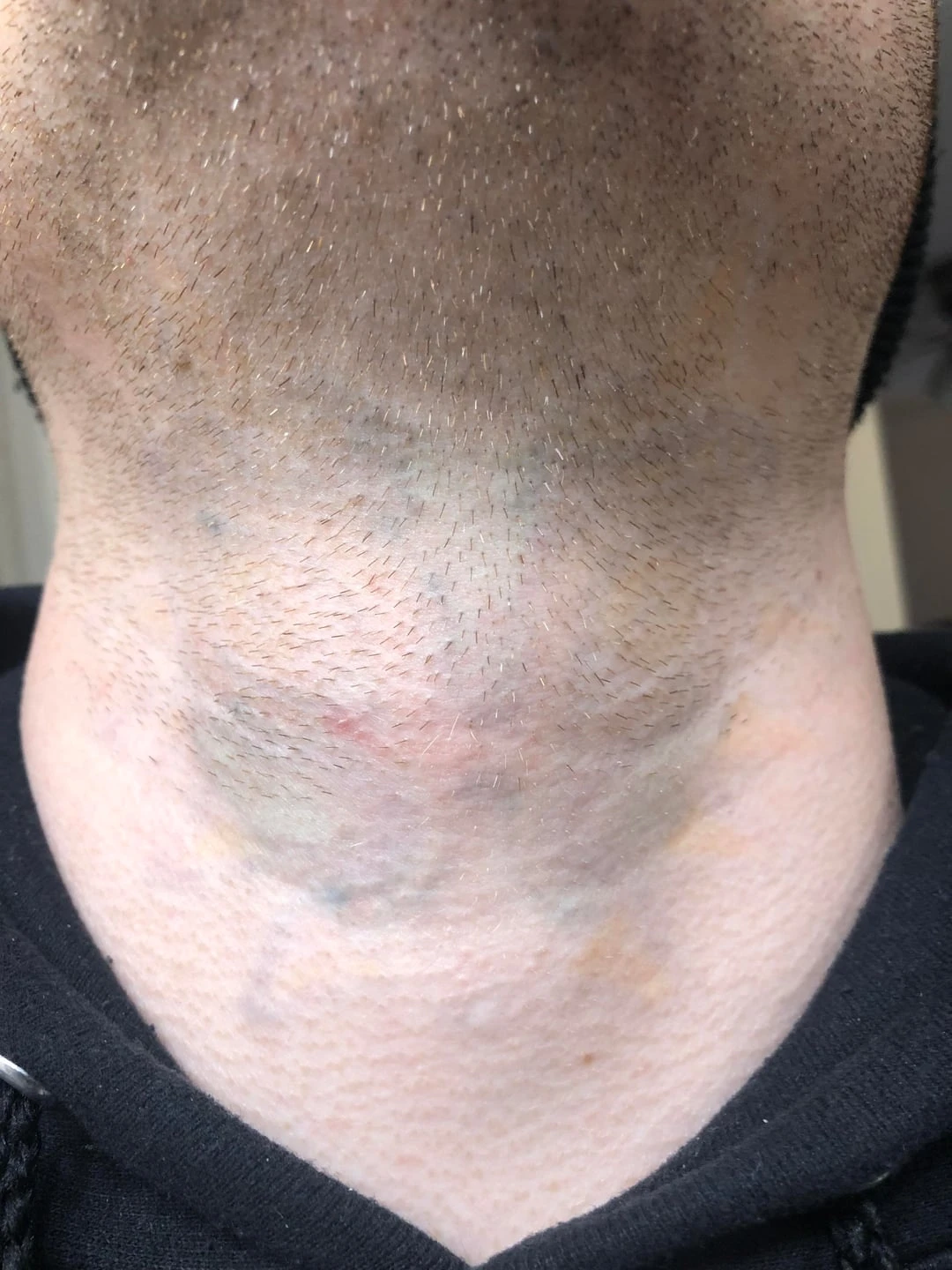 After 75% fading tattoo removal