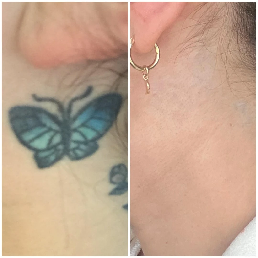 black tattoo before laser removal