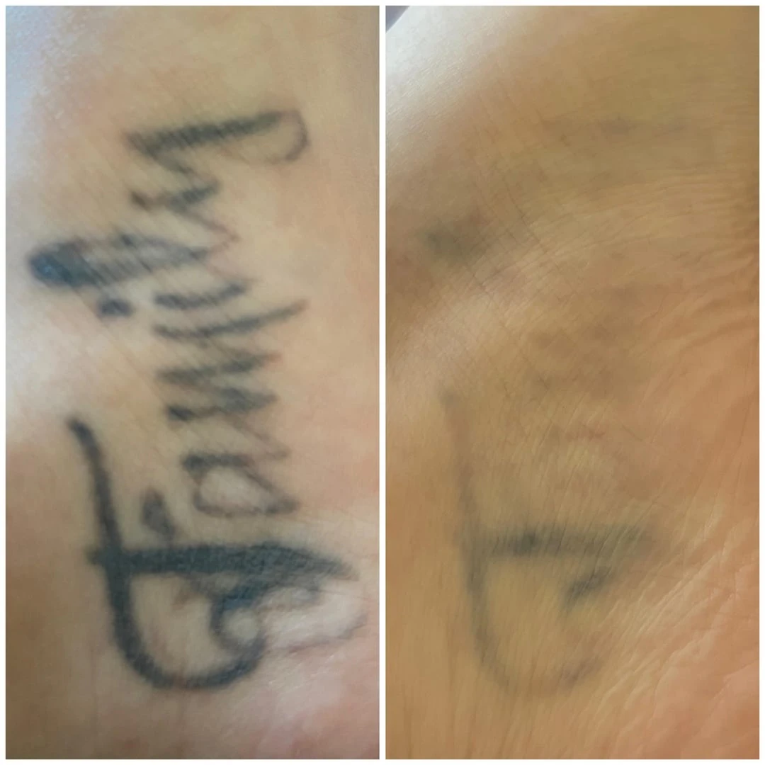 black tattoo after 15 sessions