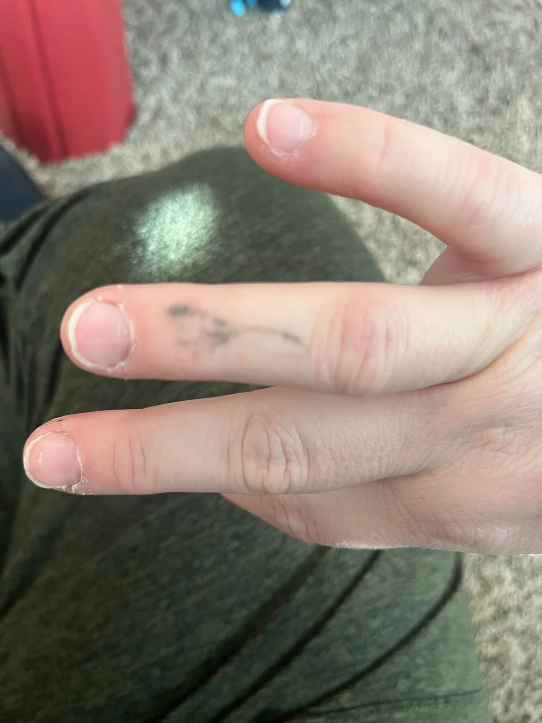 black tattoo before laser removal