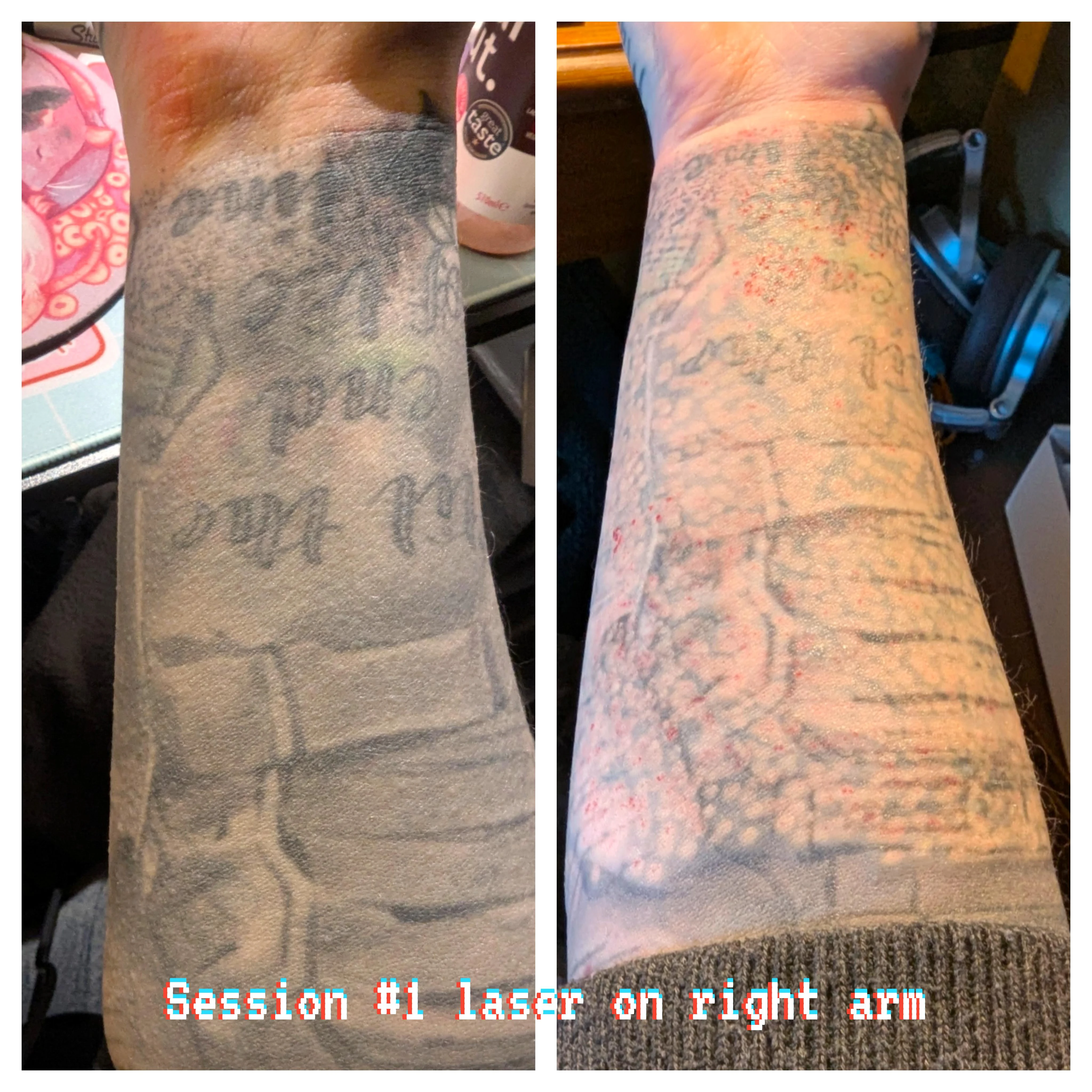 black tattoo before laser removal