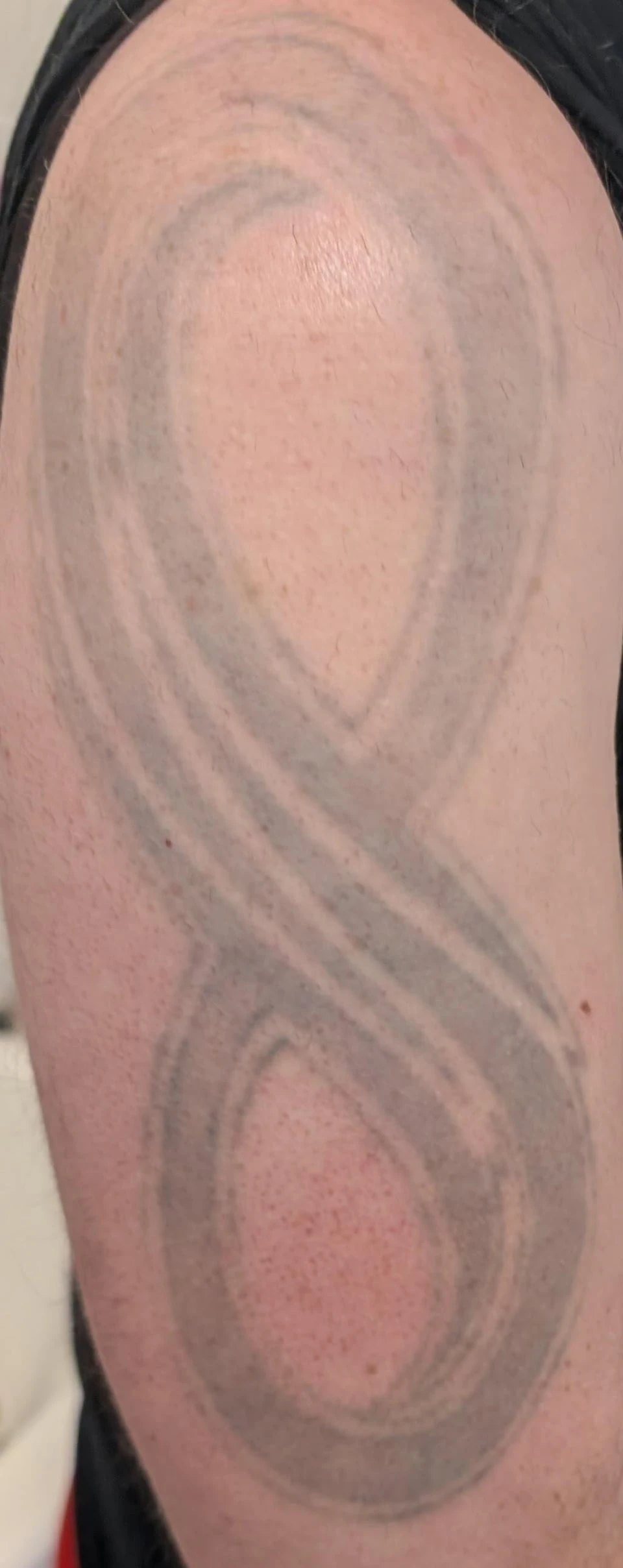 black tattoo after 12 sessions