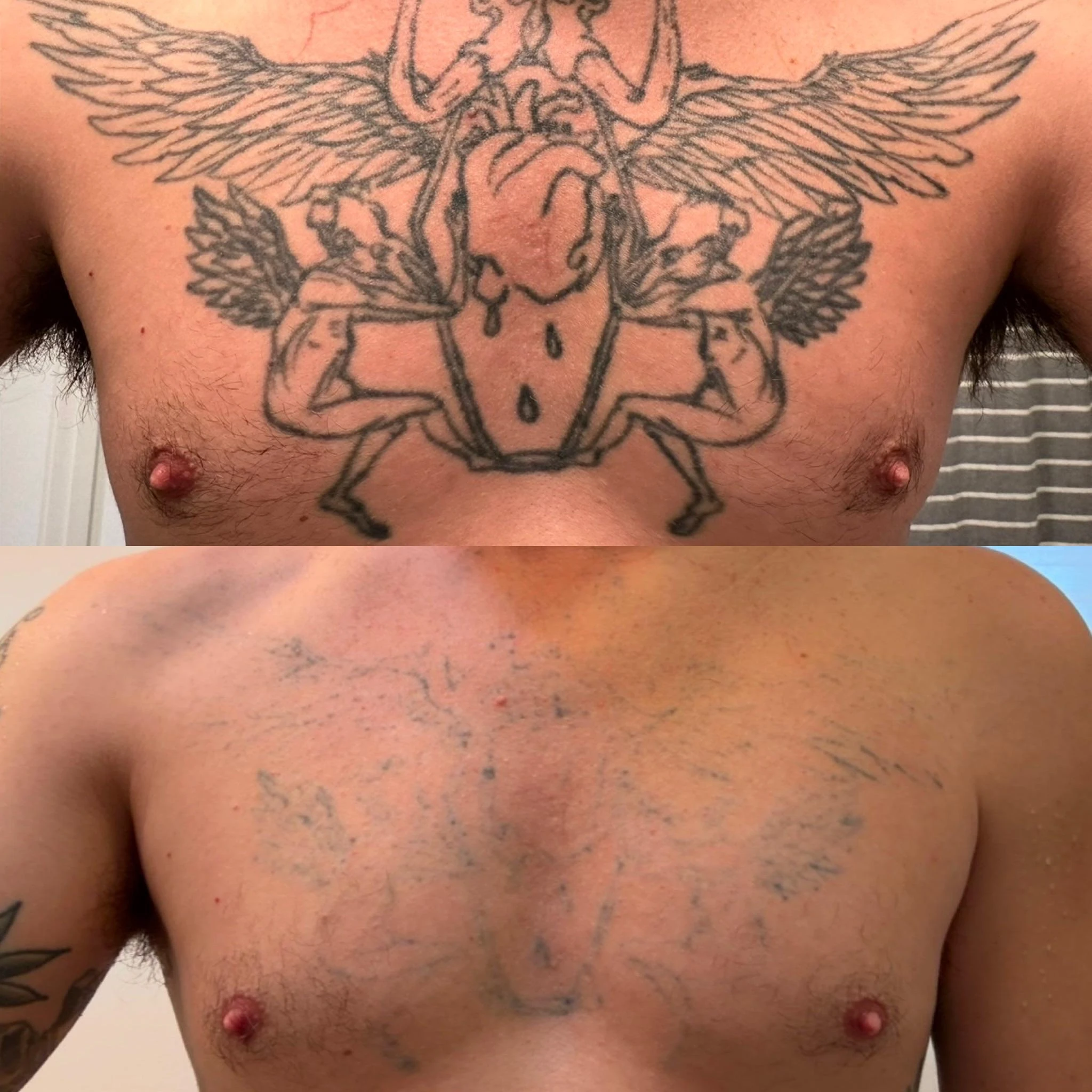 black tattoo before laser removal