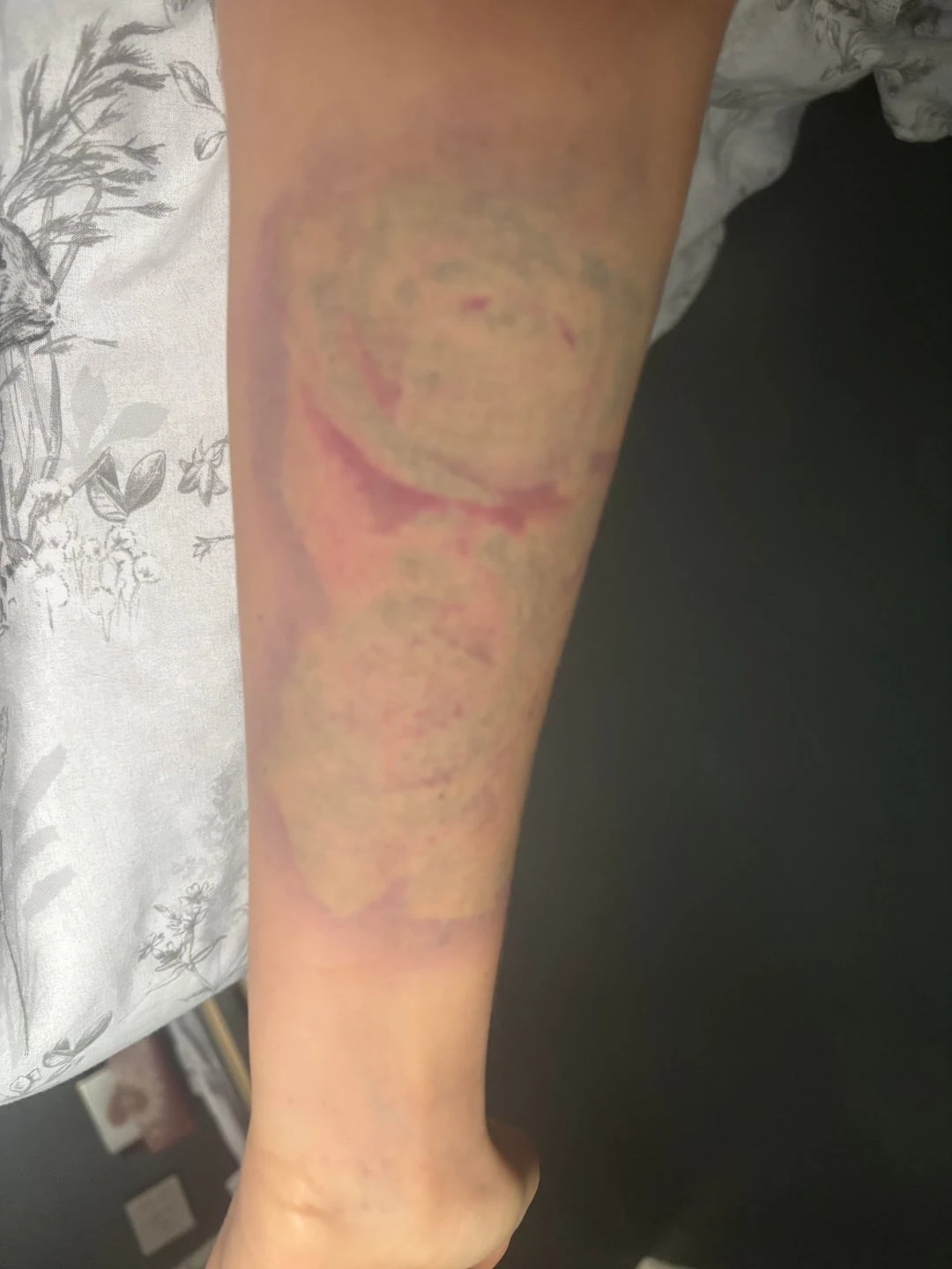 White And Pink tattoo after 4 sessions