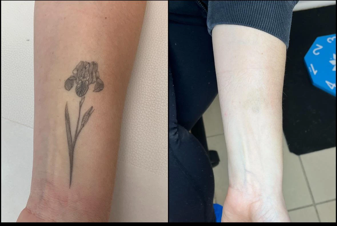 black tattoo before laser removal