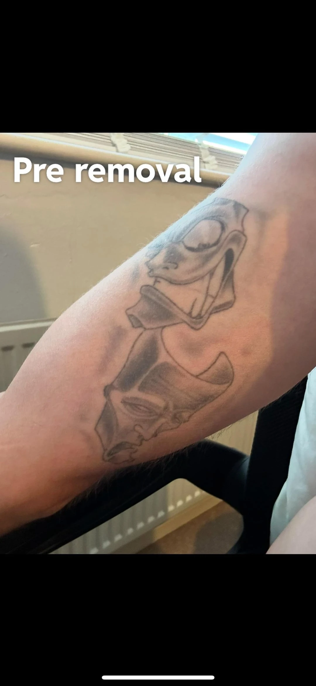 black tattoo before laser removal