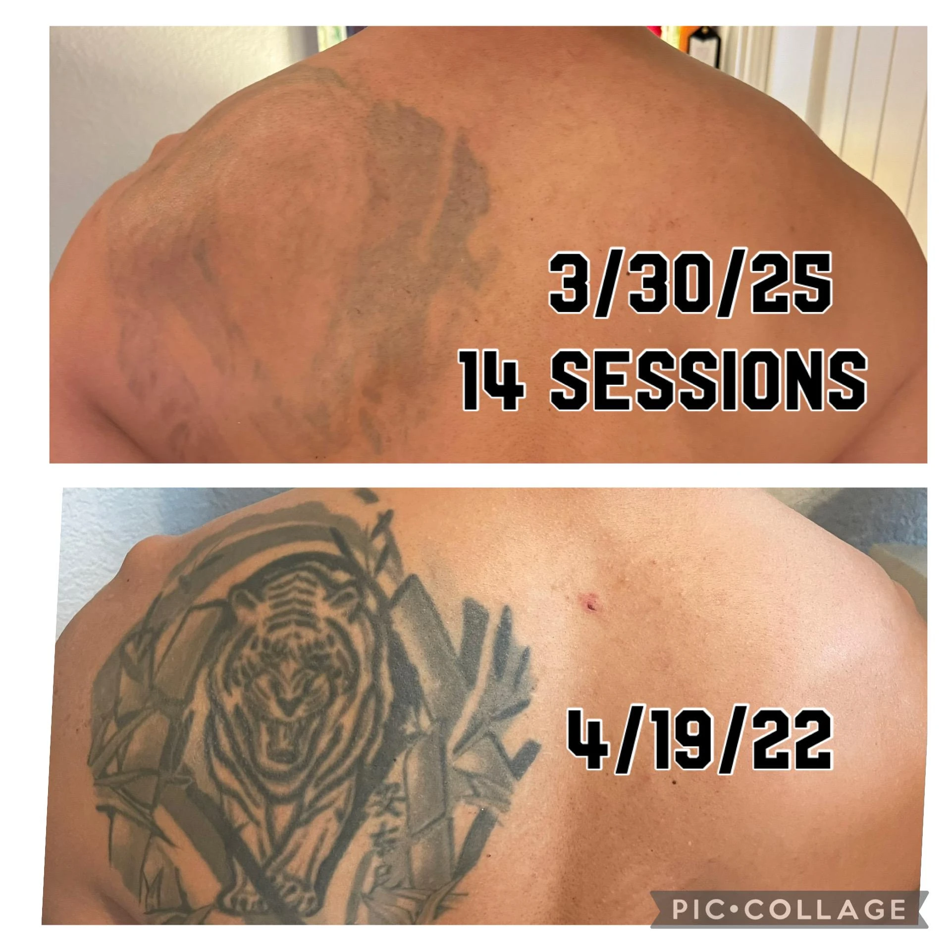 black tattoo before laser removal