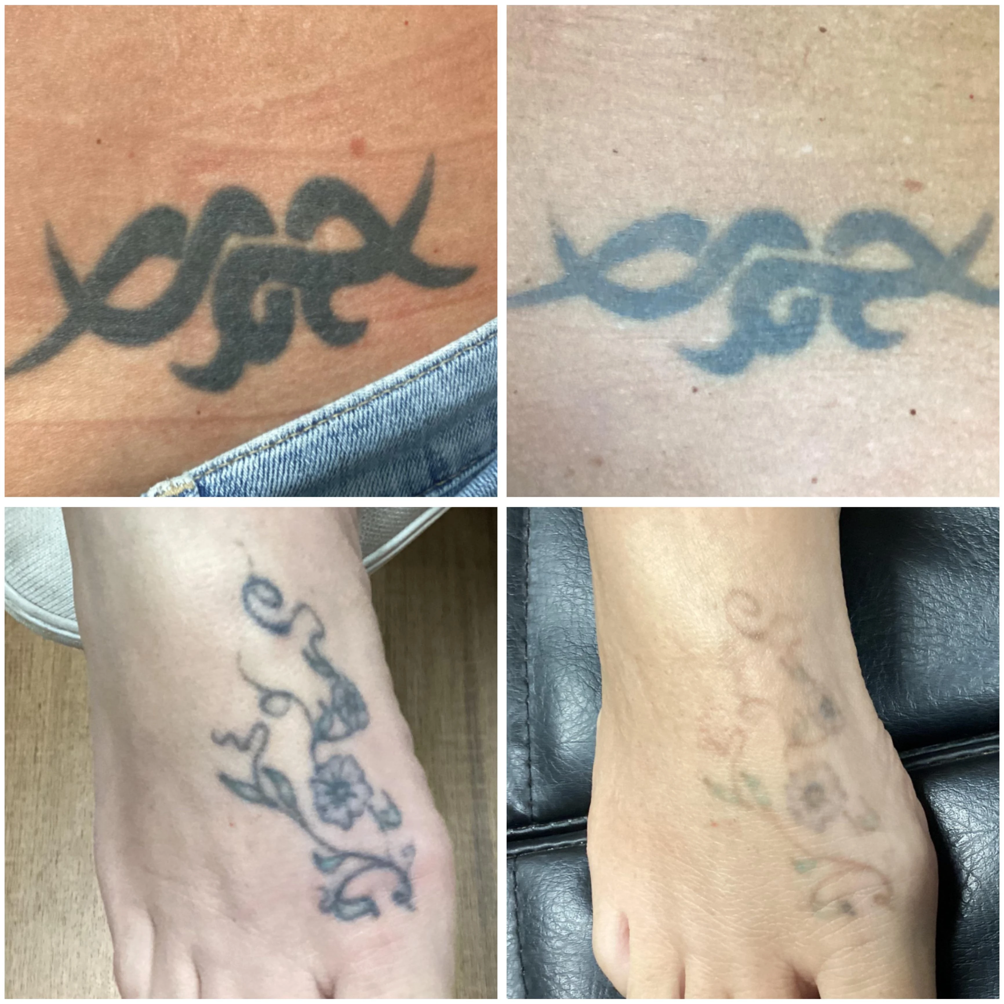 black and teal tattoo before laser removal