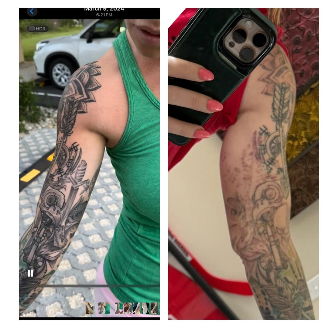 black tattoo before laser removal