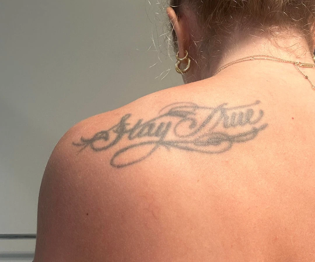 black tattoo before laser removal