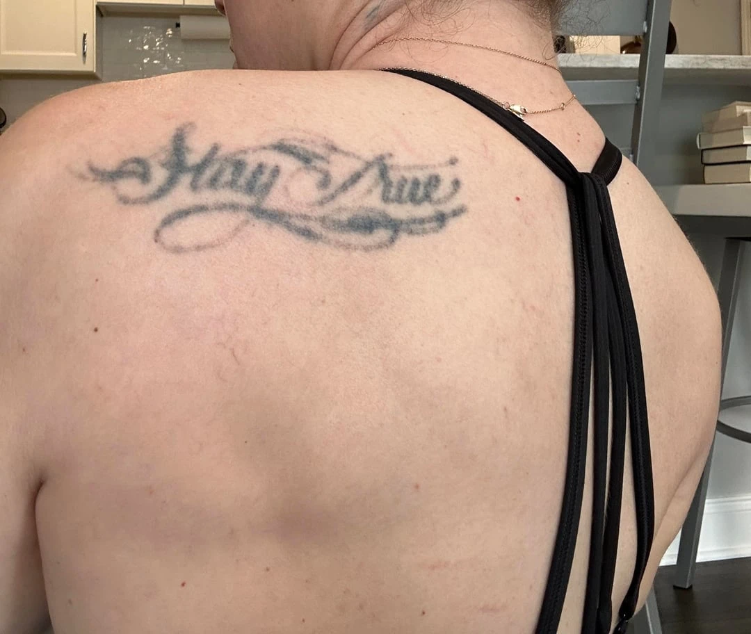 black tattoo after 1 sessions