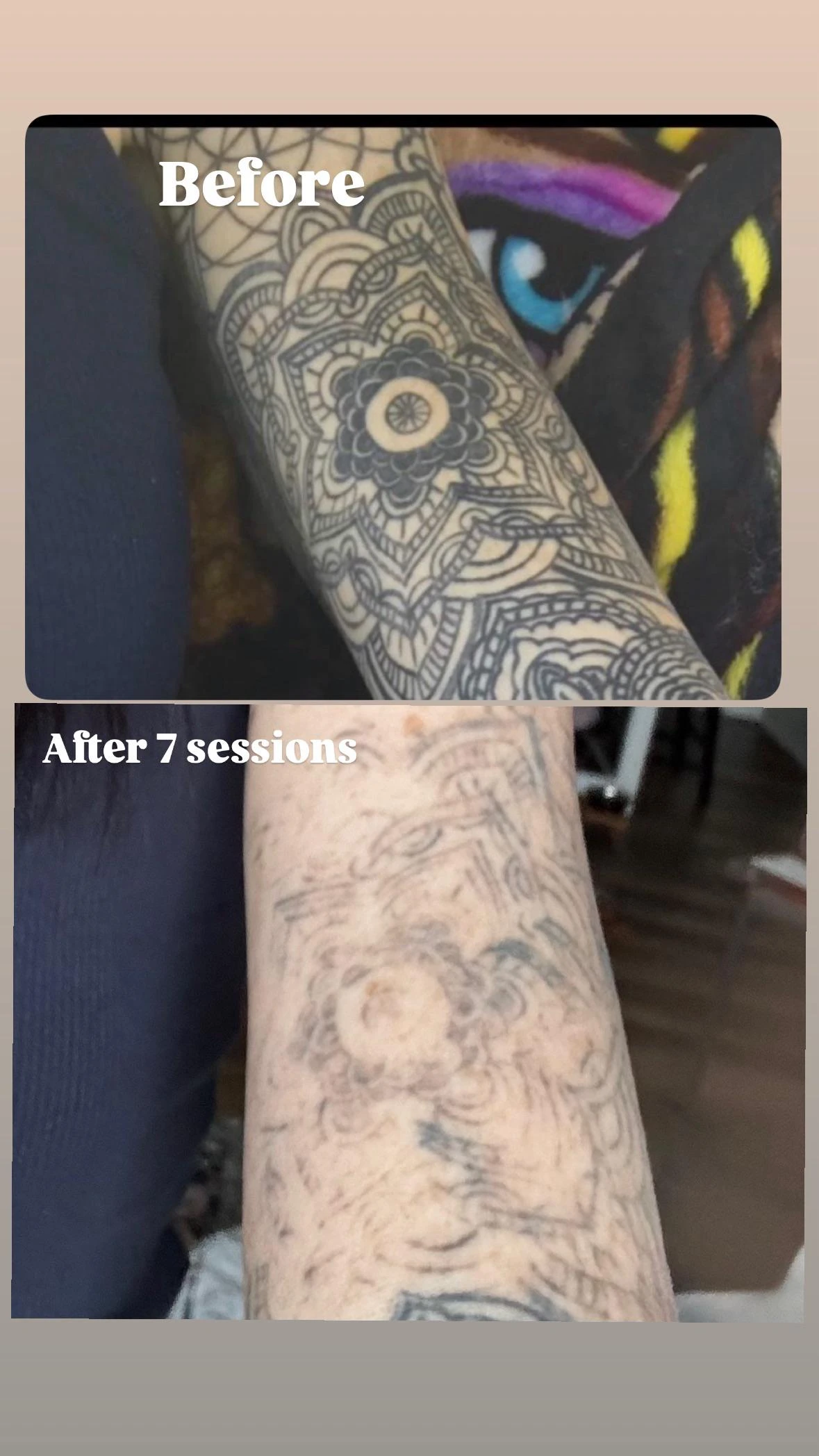 black tattoo before laser removal