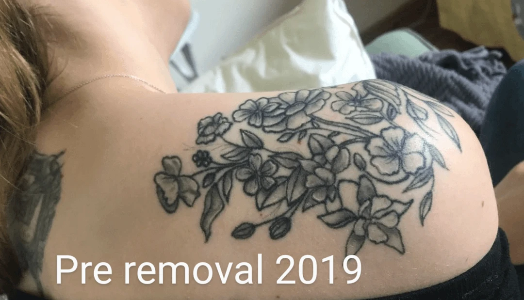 black tattoo before laser removal