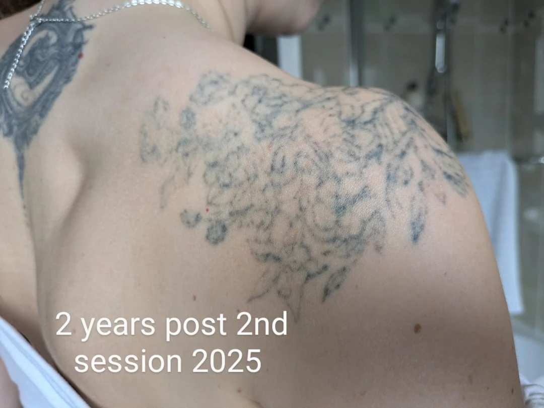 black tattoo after 2 sessions