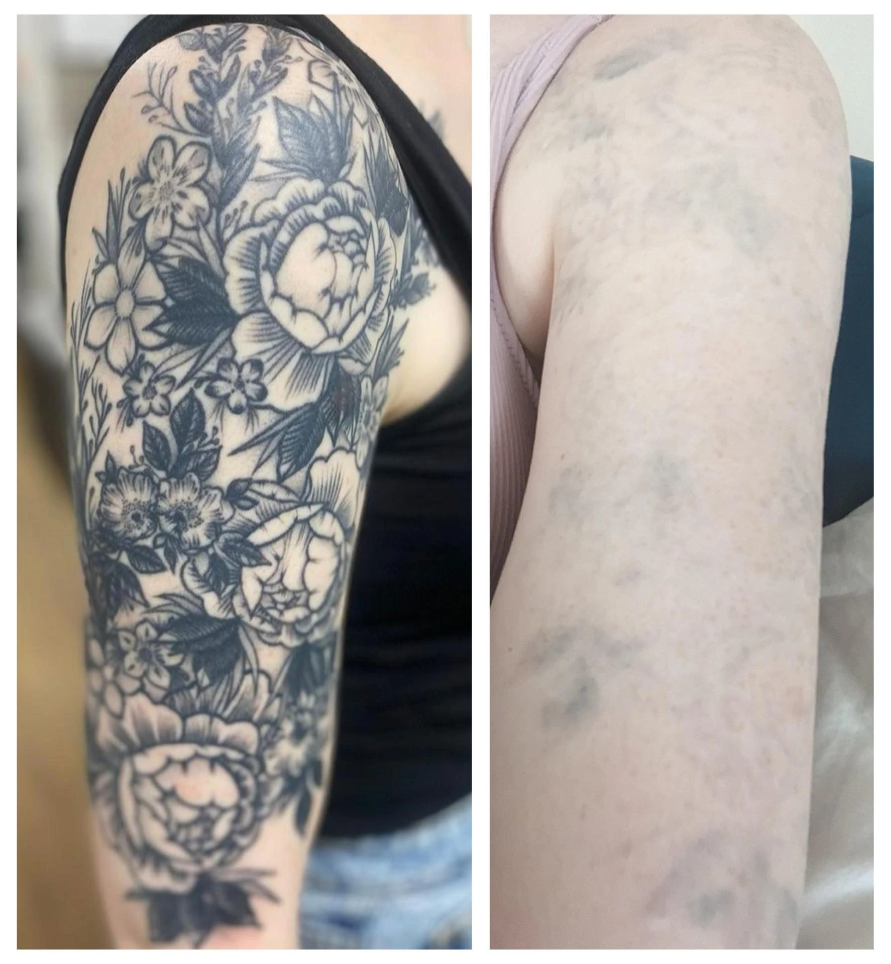 black tattoo before laser removal