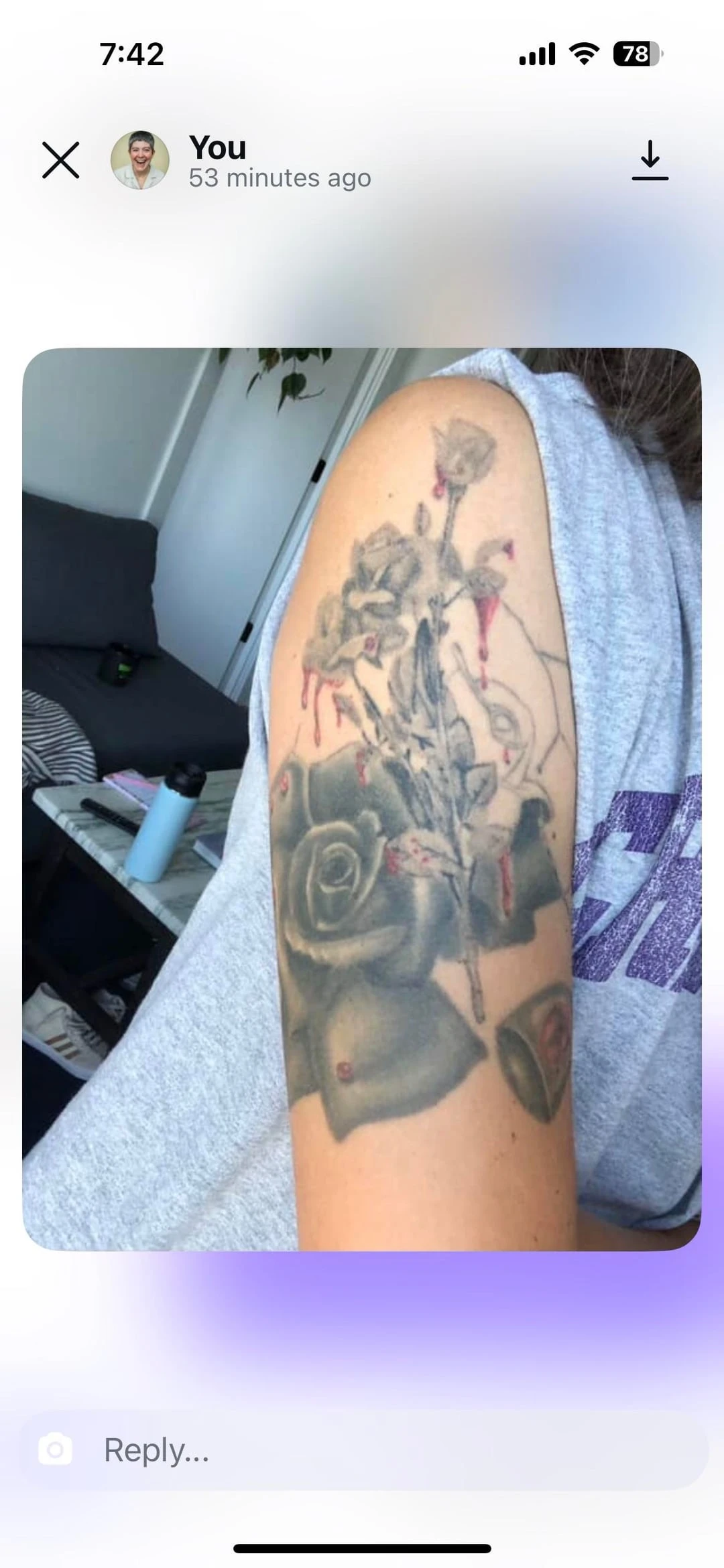 black tattoo before laser removal