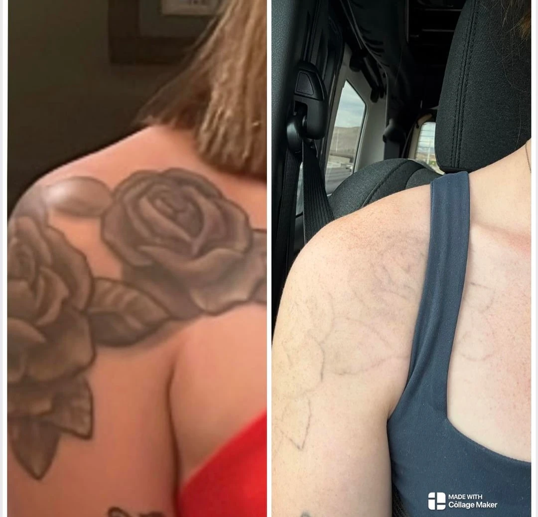 black and white tattoo before laser removal