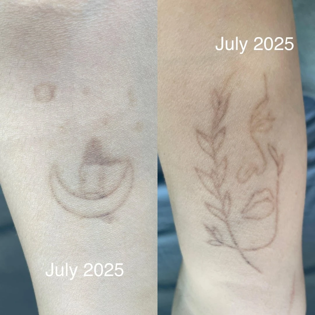 black tattoo after 2 sessions