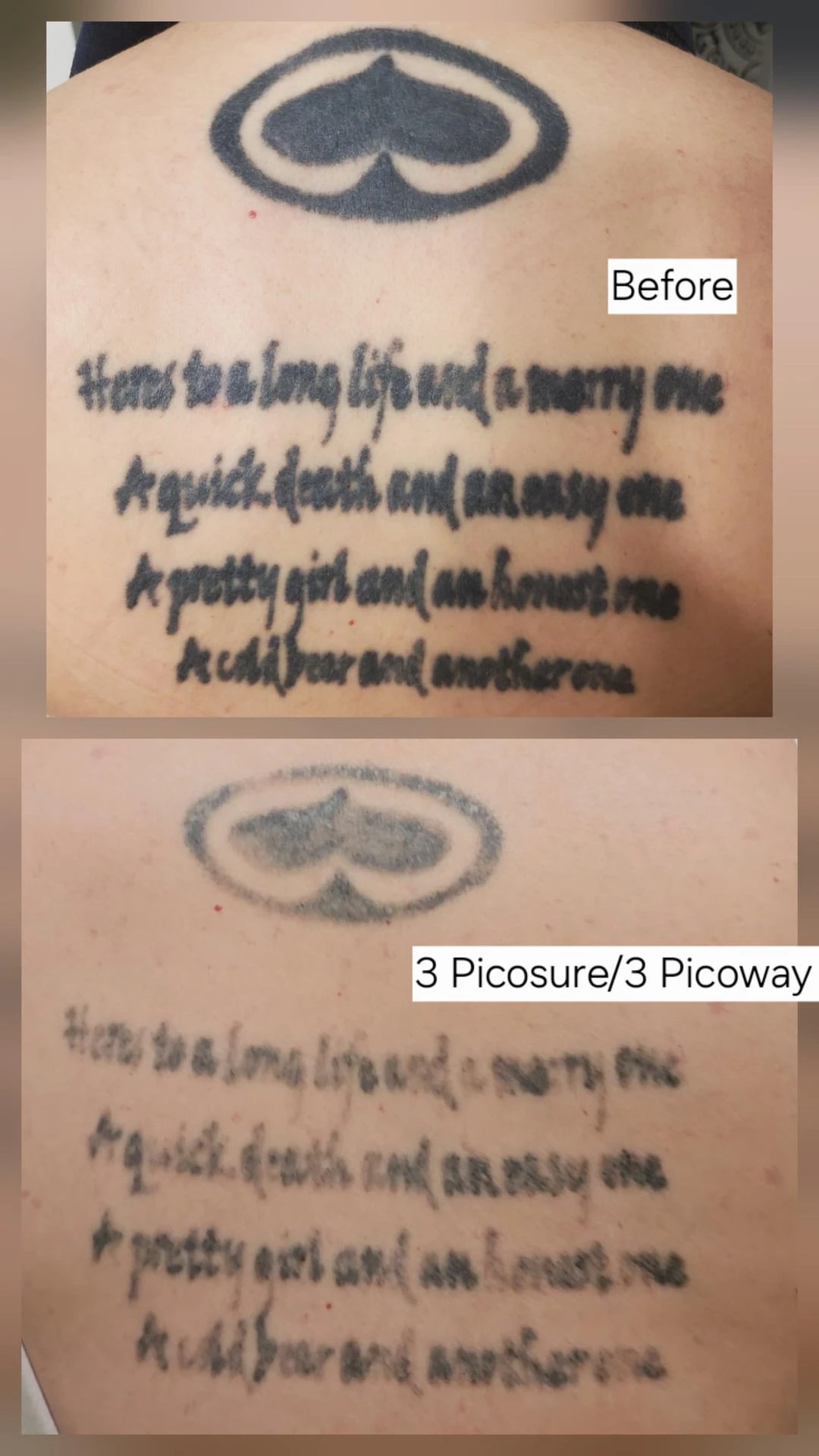 black tattoo before laser removal