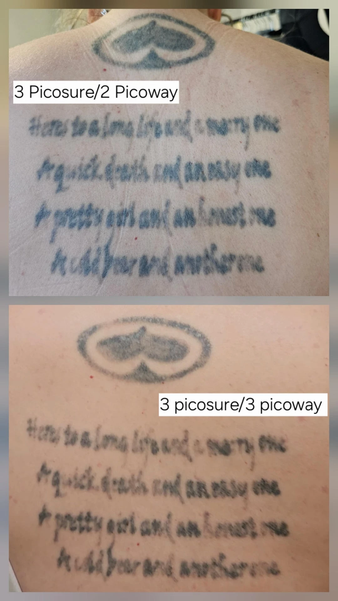 black tattoo after 6 sessions