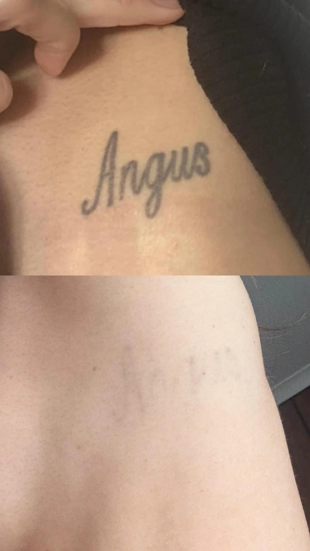 black tattoo before laser removal