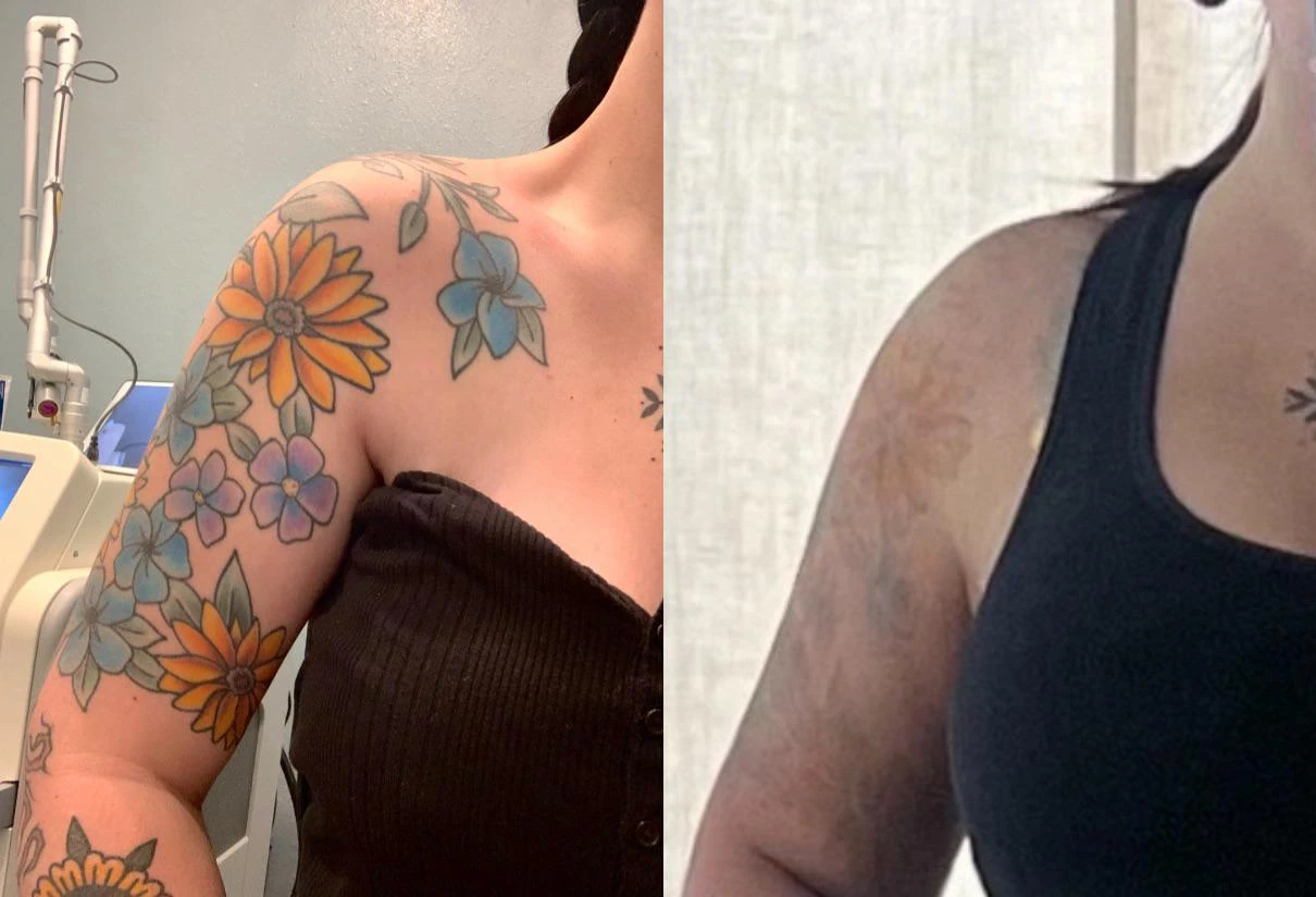blue, orange, purple, green and yellow tattoo before laser removal